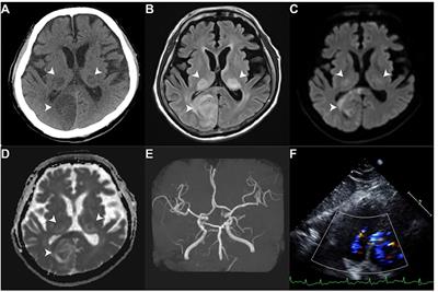 Functional outcome prediction of ischemic stroke patients with atrial fibrillation accepting post-acute care training